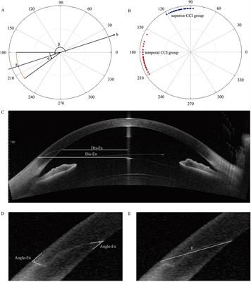 Effects of clear corneal incision location and morphology on corneal surgically induced astigmatism and higher-order aberrations after ICL V4c implantation